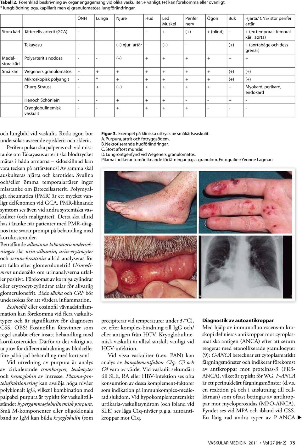 njur- artär - (+) - - (+) + (aortabåge och dess grenar) Medelstora Polyarteritis nodosa - - (+) + + + + + + kärl Små kärl Wegeners granulomatos + + + + + + + (+) (+) Mikroskopisk polyangit - * + + +