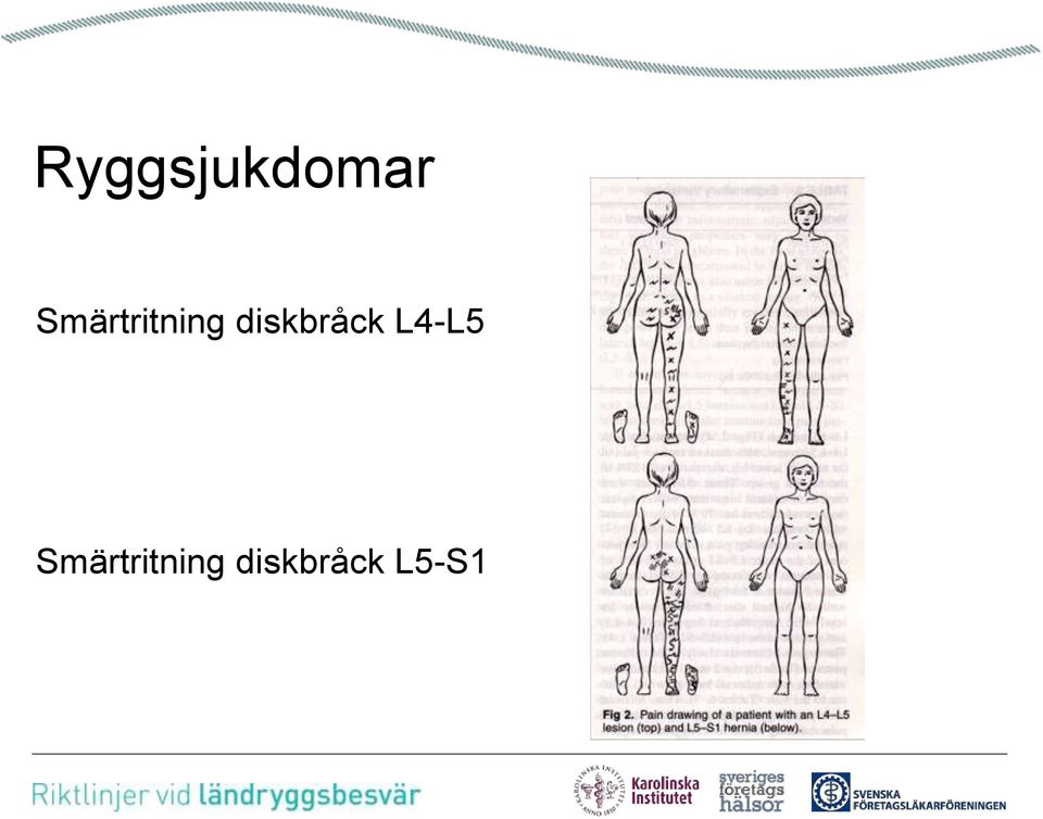 diskbråck L4-L5 