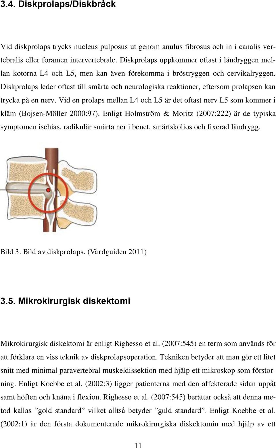 Diskprolaps leder oftast till smärta och neurologiska reaktioner, eftersom prolapsen kan trycka på en nerv.