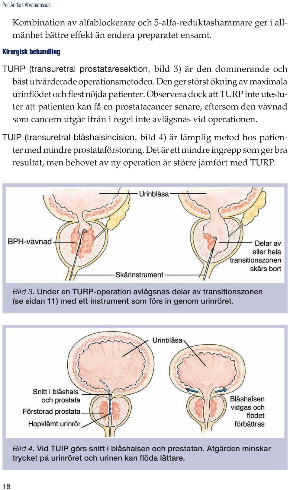 Observera dock att TURP inte utesluter att patienten kan få en prostatacancer senare, eftersom den vävnad som cancern utgår ifrån i regel inte avlägsnas vid operationen.