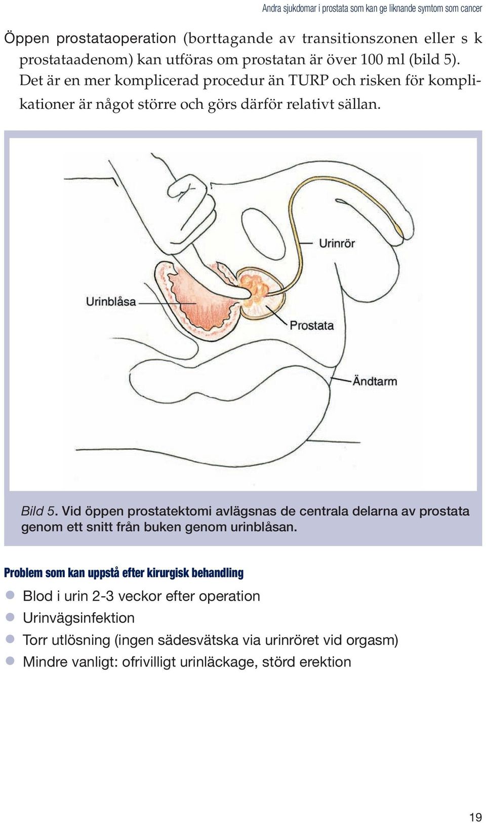 Vid öppen prostatektomi avlägsnas de centrala delarna av prostata genom ett snitt från buken genom urinblåsan.