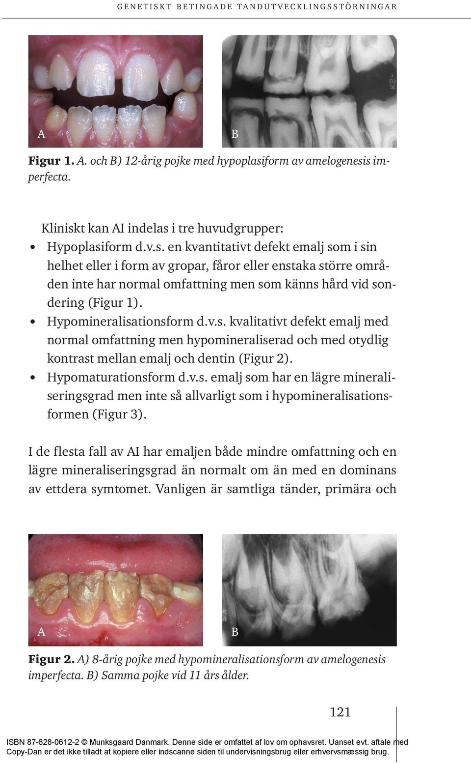 Hypomineralisationsform d.v.s. kvalitativt defekt emalj med normal omfattning men hypomineraliserad och med otydlig kontrast mellan emalj och dentin (Figur 2). Hypomaturationsform d.v.s. emalj som har en lägre mineraliseringsgrad men inte så allvarligt som i hypomineralisationsformen (Figur 3).