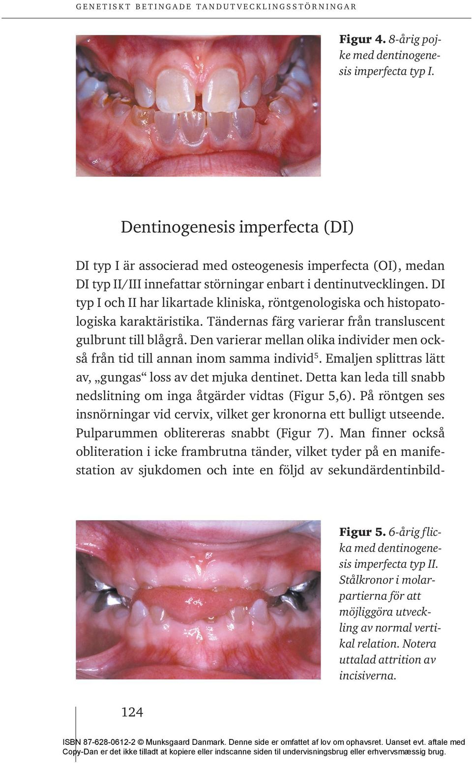 DI typ I och II har likartade kliniska, röntgenologiska och histopatologiska karaktäristika. Tändernas färg varierar från transluscent gulbrunt till blågrå.