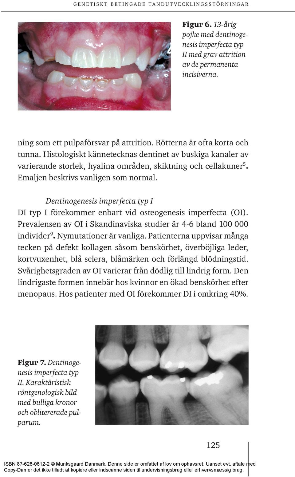 Dentinogenesis imperfecta typ I DI typ I förekommer enbart vid osteogenesis imperfecta (OI). Prevalensen av OI i Skandinaviska studier är 4-6 bland 100 000 individer 9. Nymutationer är vanliga.