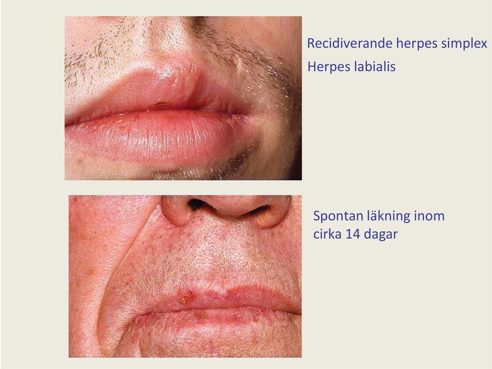 Herpes labialis