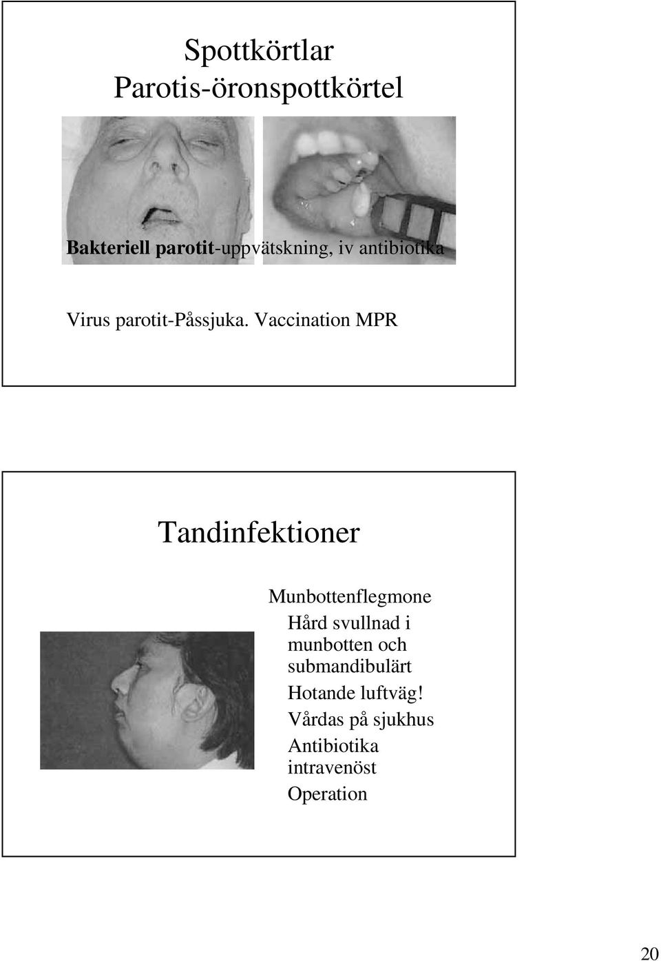 Vaccination MPR Tandinfektioner Munbottenflegmone Hård svullnad i