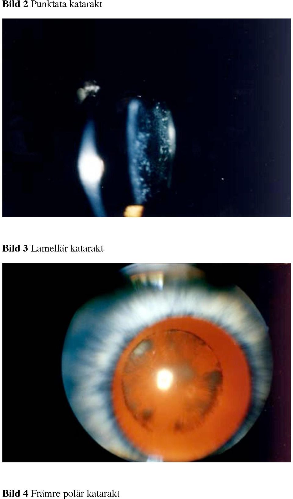 Lamellär katarakt