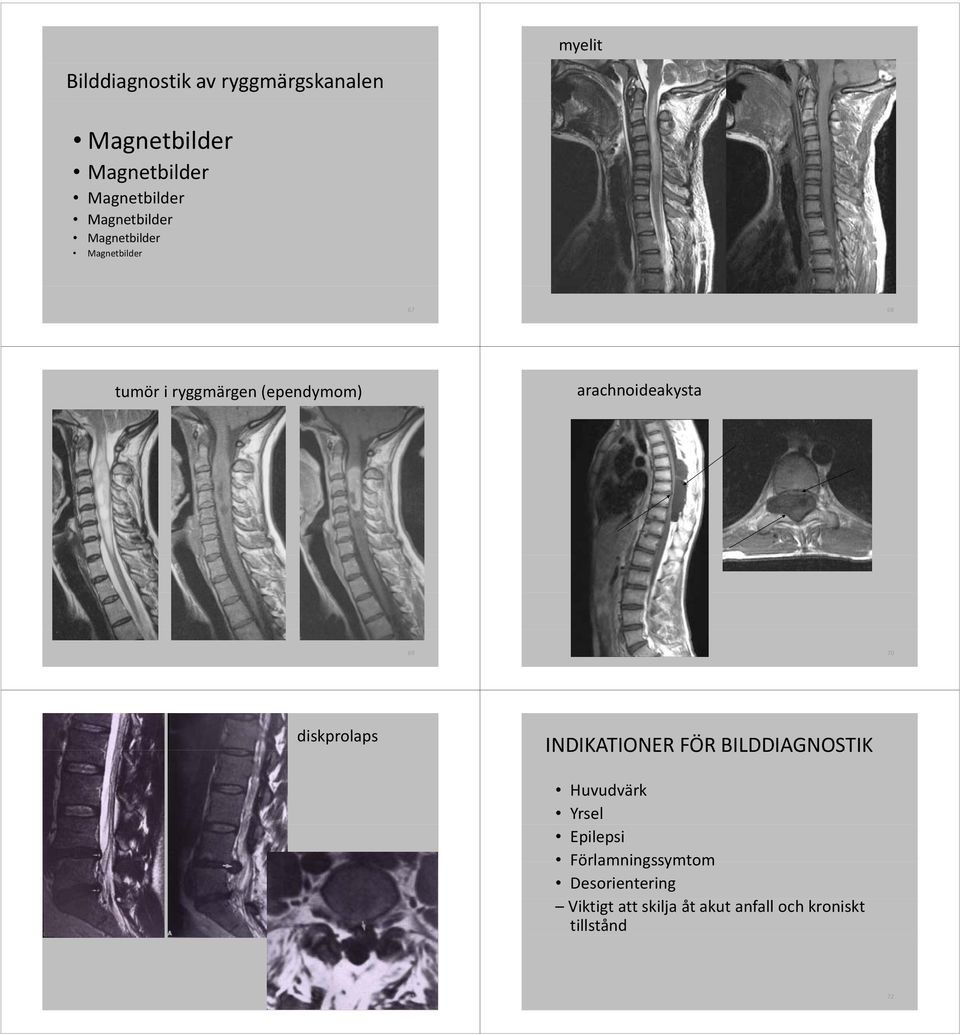 arachnoideakysta 69 70 diskprolaps INDIKATIONERFÖR BILDDIAGNOSTIK Huvudvärk Yrsel