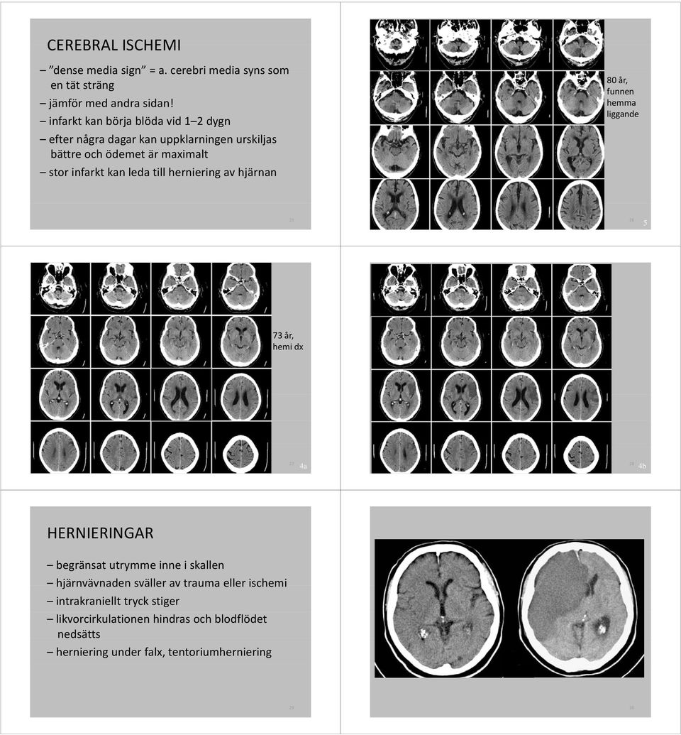 till herniering av hjärnan 80 år, funnen hemma liggande 25 26 5 73 år, hemi dx 27 4a 28 4b HERNIERINGAR begränsat utrymme inne i skallen
