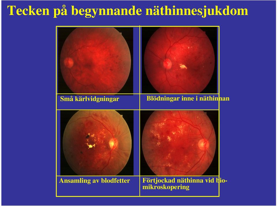 näthinnan Ansamling av blodfetter