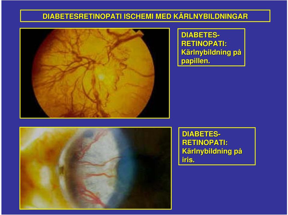 RETINOPATI: Kärlnybildning påp