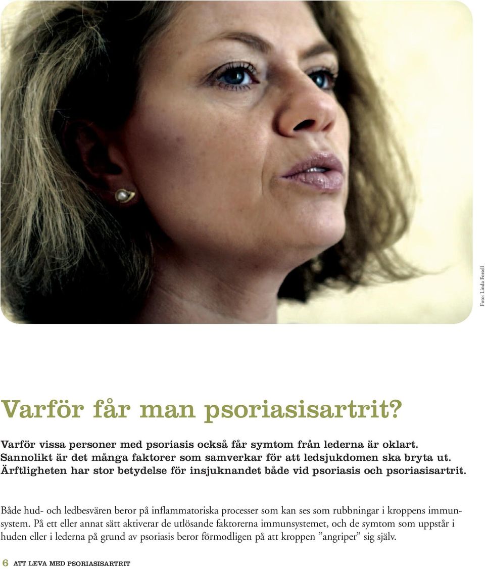 Ärftligheten har stor betydelse för insjuknandet både vid psoriasis och psoriasisartrit.