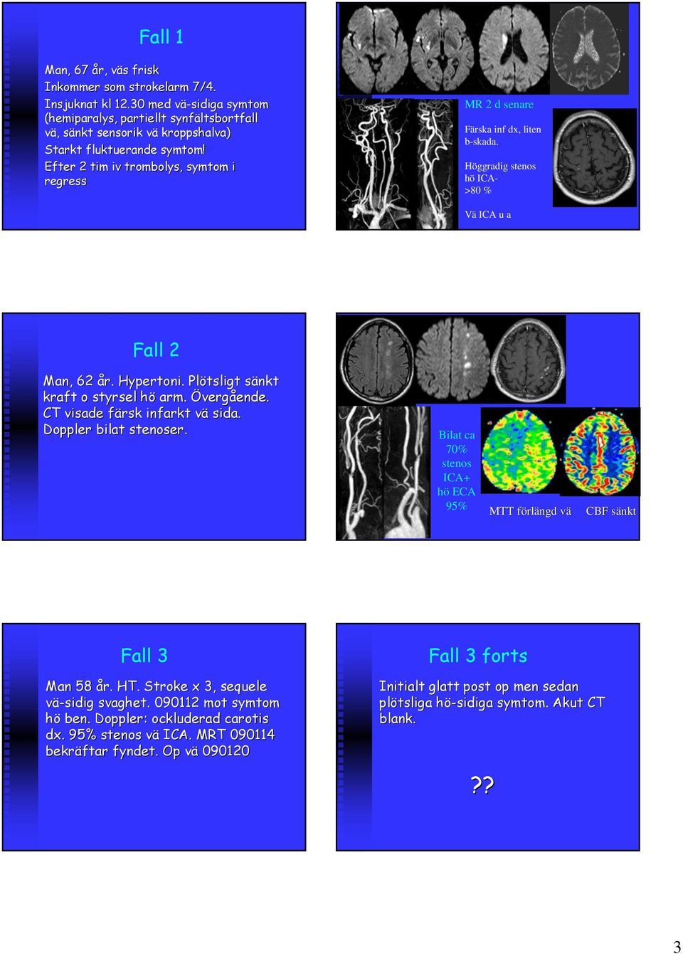 Efter 2 tim iv trombolys,, symtom i regress MR 2 d senare Färska inf dx, liten b-skada. Höggradig stenos hö ICA- >80 % Vä ICA u a Fall 2 Man, 62 år. Hypertoni. Plötsligt sänkt kraft o styrsel hö arm.