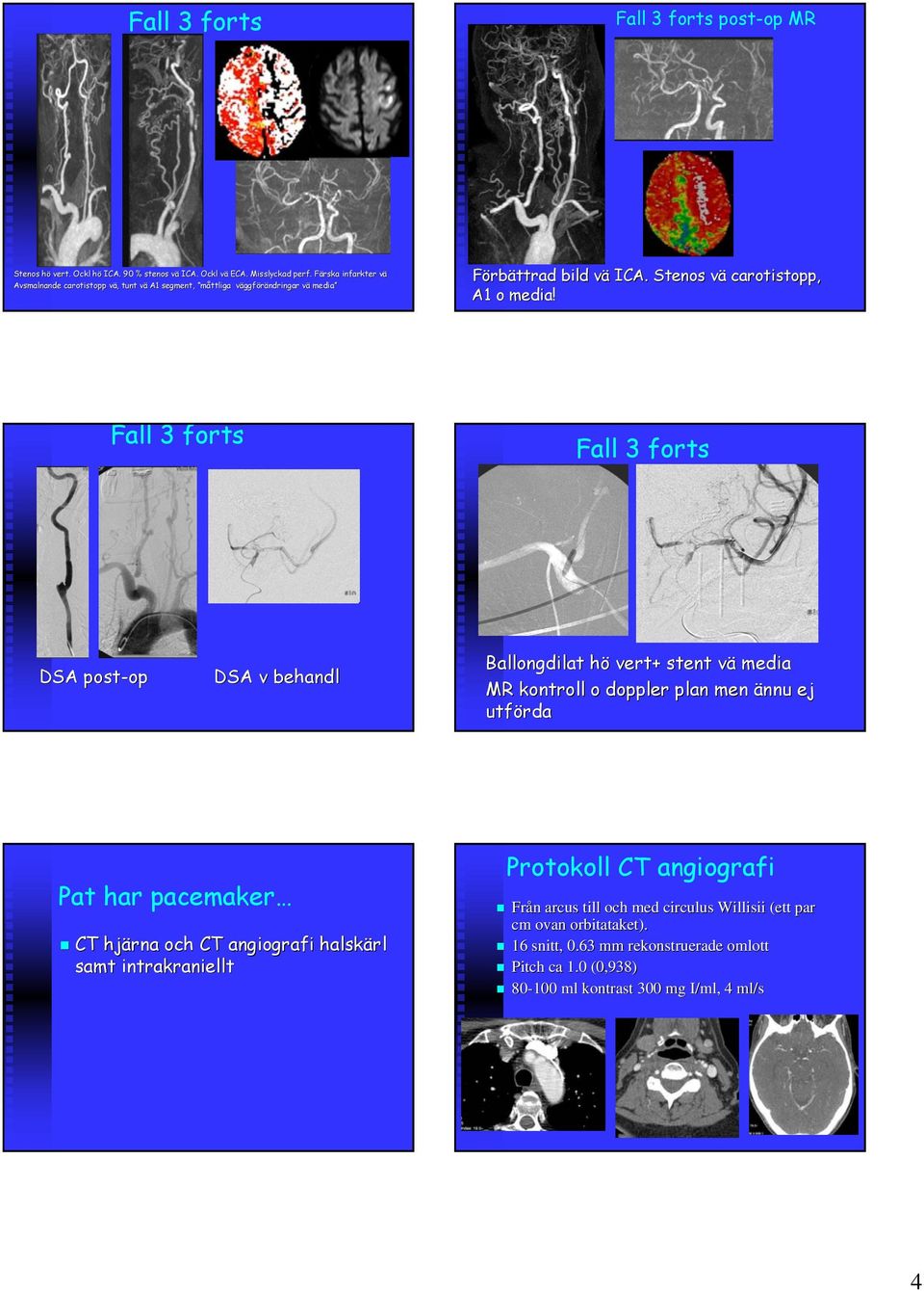 Fall 3 forts Fall 3 forts DSA post-op op DSA v behandl Ballongdilat hö vert+ stent vä media MR kontroll o doppler plan men ännu ej utförda Pat har pacemaker CT hjärna och