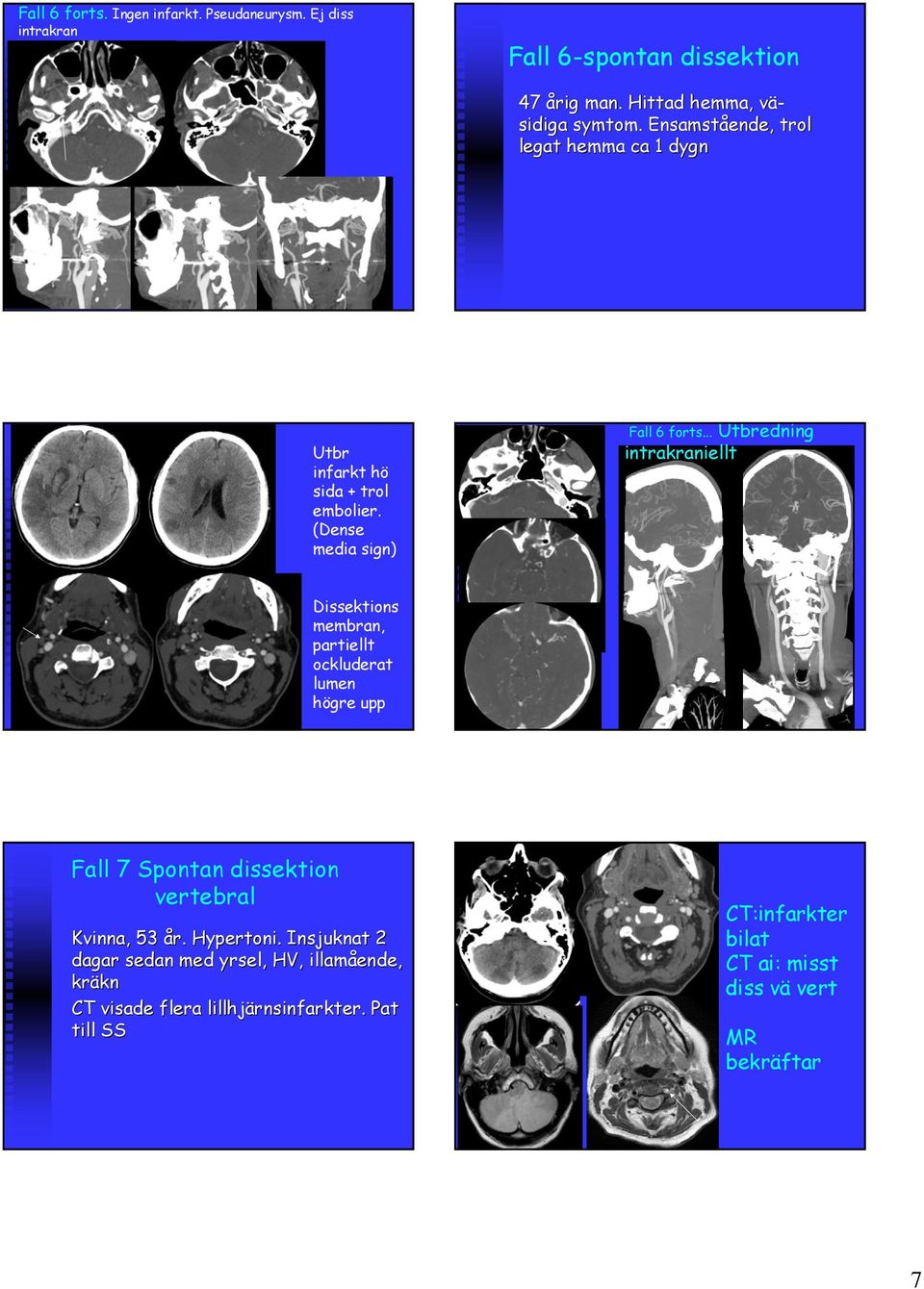 .. Utbredning intrakraniellt Dissektions membran, partiellt ockluderat lumen högre upp Fall 7 Spontan dissektion vertebral Kvinna, 53 år.