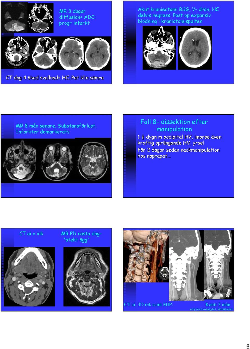 Infarkter demarkerats Fall 8- dissektion efter manipulation 1 ½ dygn m occipital HV, imorse även kraftig sprängande HV, yrsel