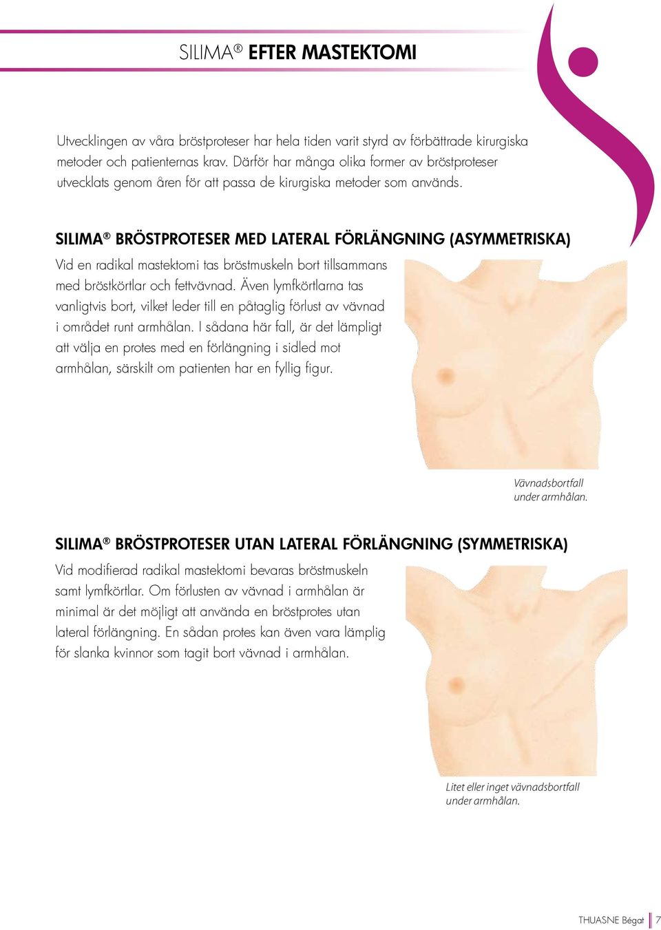 Silima bröstproteser med lateral förlängning (asymmetriska) Vid en radikal mastektomi tas bröstmuskeln bort tillsammans med bröstkörtlar och fettvävnad.