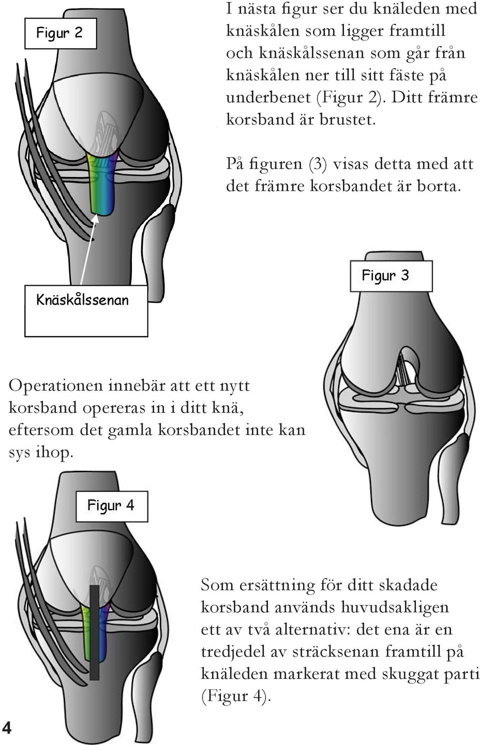 Knäskålssenan Operationen innebär att ett nytt korsband opereras in i ditt knä, eftersom det gamla korsbandet inte kan sys ihop.