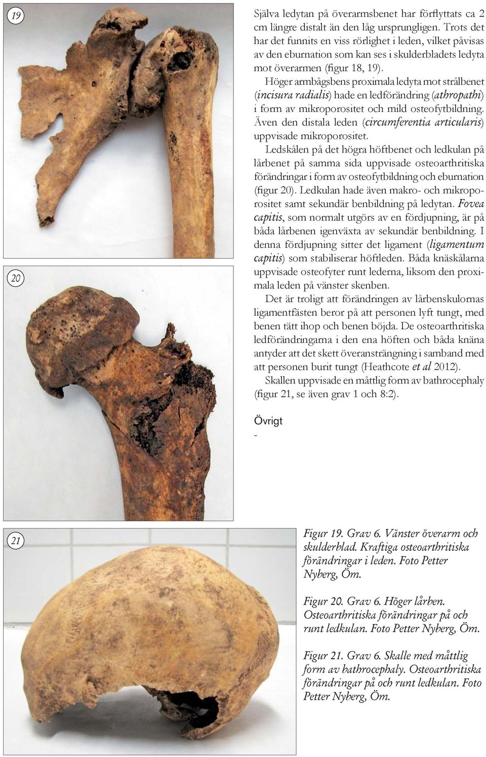 Höger armbågsbens proximala ledyta mot strålbenet (incisura radialis) hade en ledförändring (athropathi) i form av mikroporositet och mild osteofytbildning.