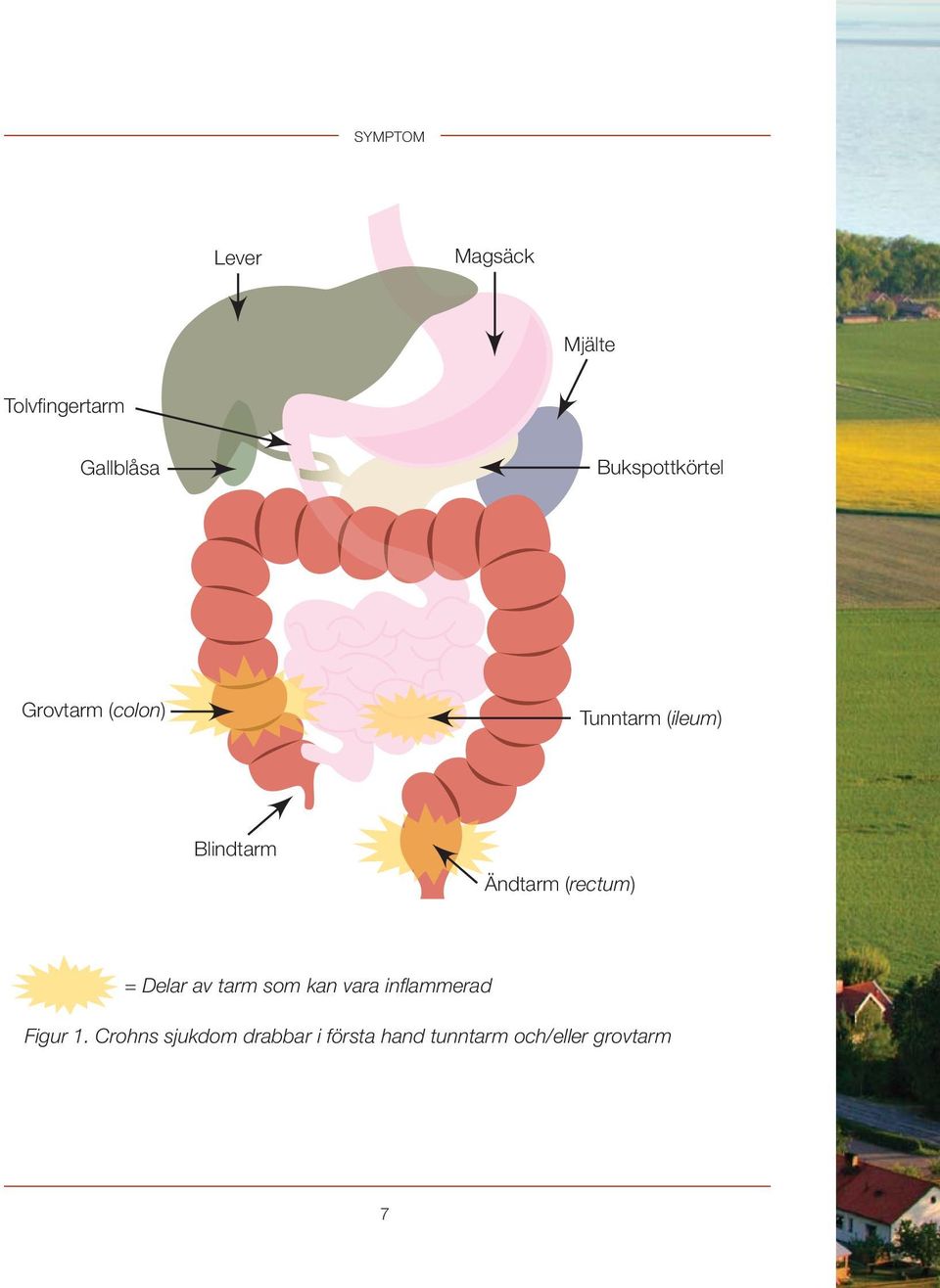 Ändtarm (rectum) = Delar av tarm som kan vara inflammerad