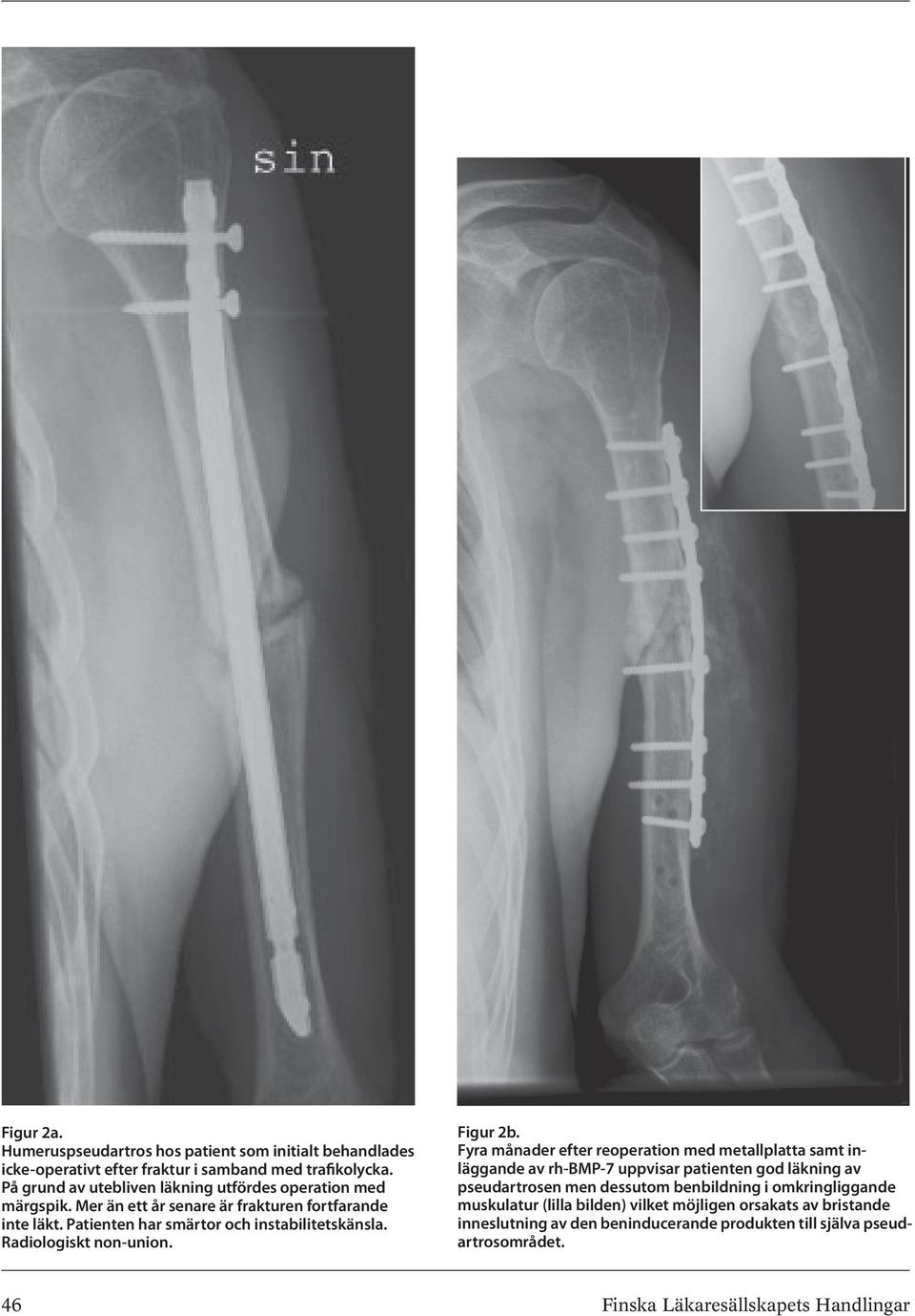 Radiologiskt non-union. Figur 2b.