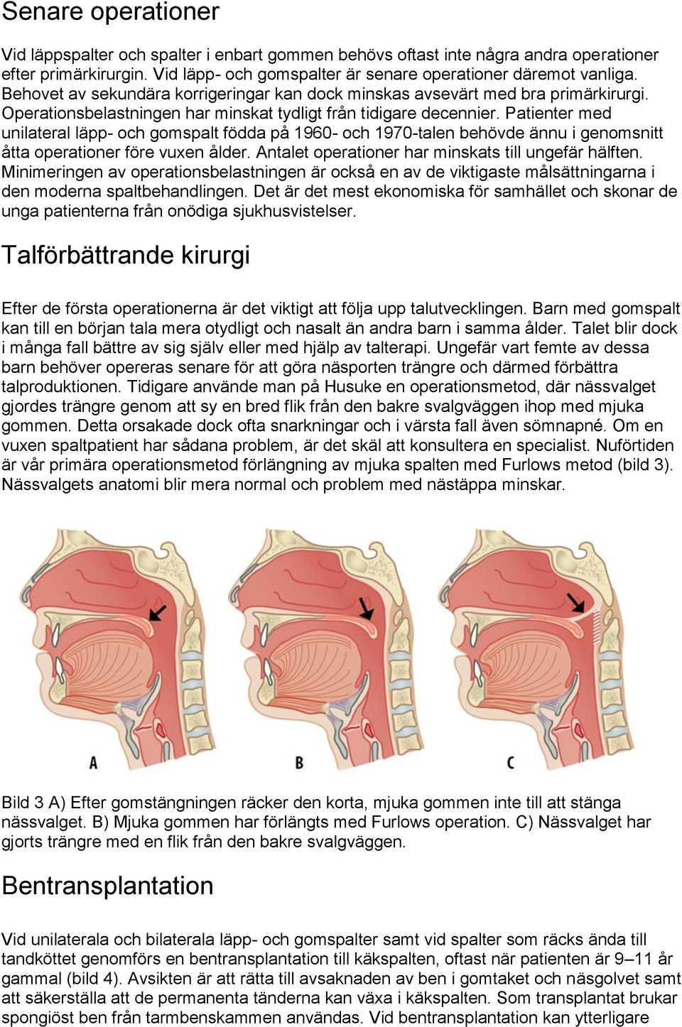 Patienter med unilateral läpp- och gomspalt födda på 1960- och 1970-talen behövde ännu i genomsnitt åtta operationer före vuxen ålder. Antalet operationer har minskats till ungefär hälften.