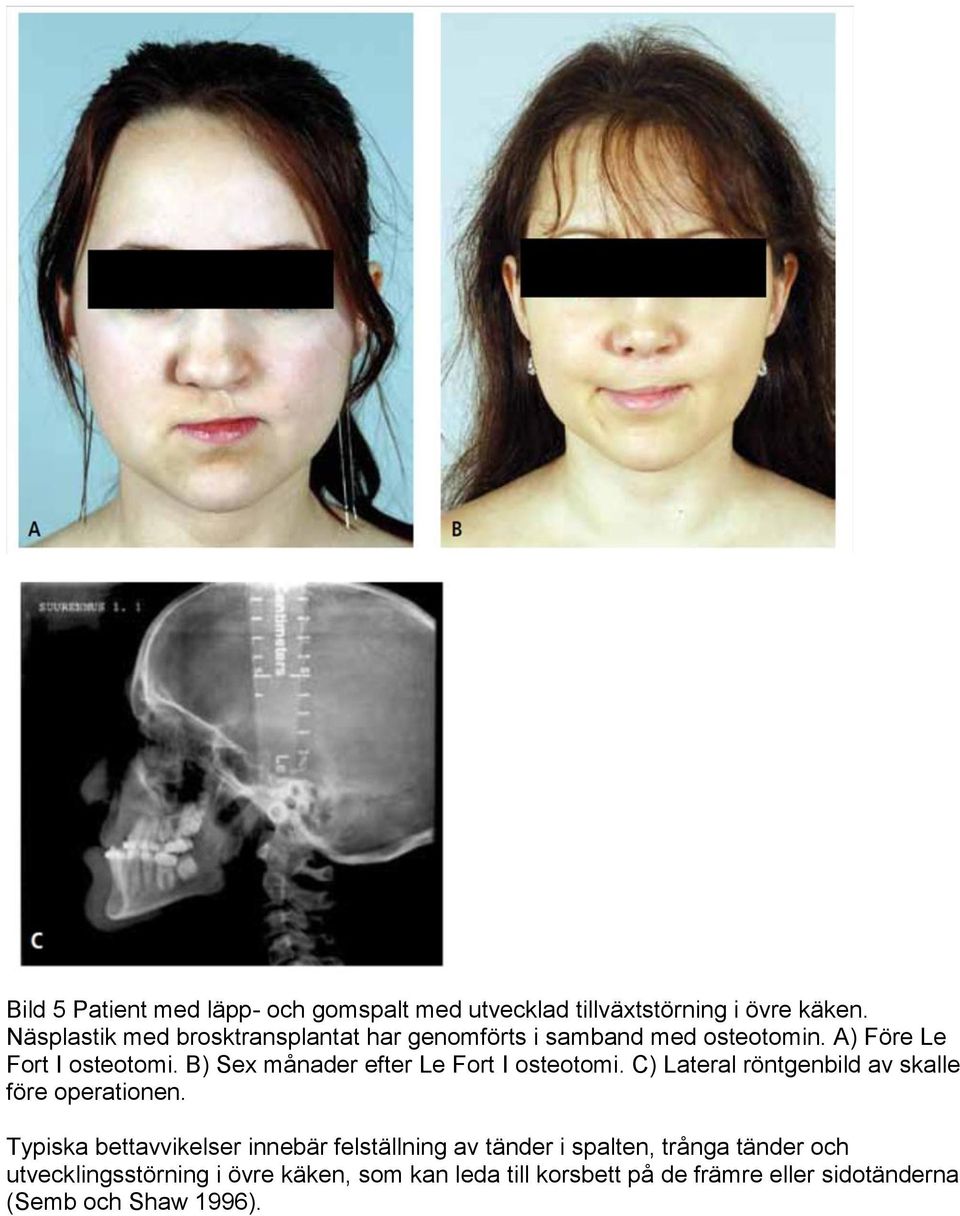 B) Sex månader efter Le Fort I osteotomi. C) Lateral röntgenbild av skalle före operationen.