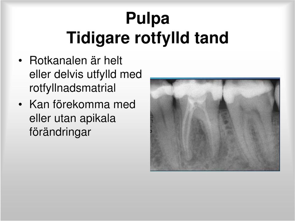 utfylld med rotfyllnadsmatrial Kan