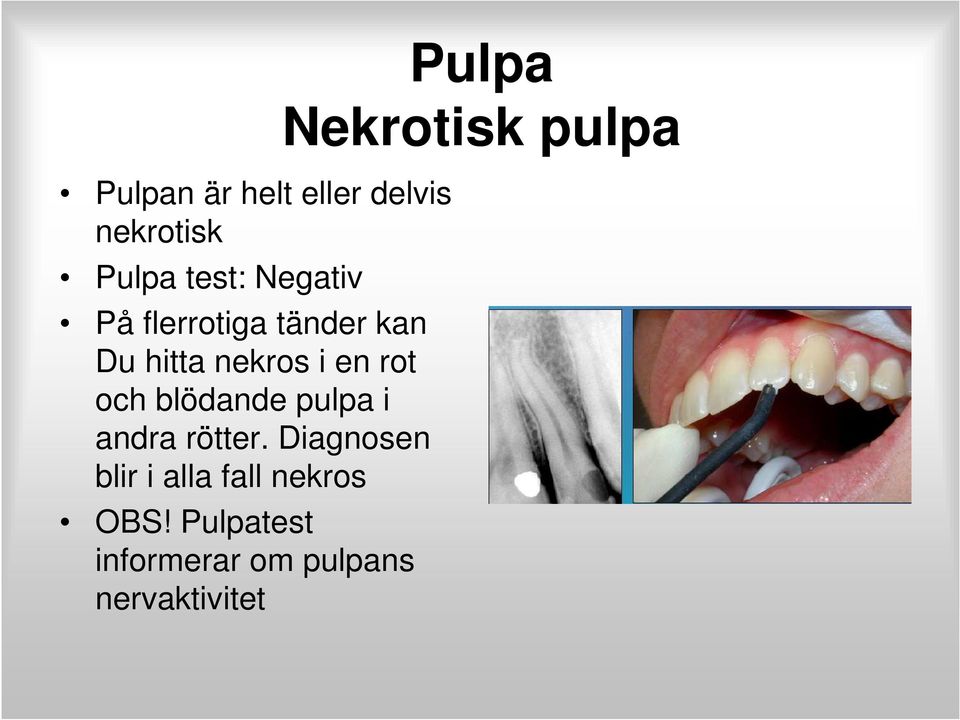 pulpa i andra rötter. Diagnosen blir i alla fall nekros OBS!