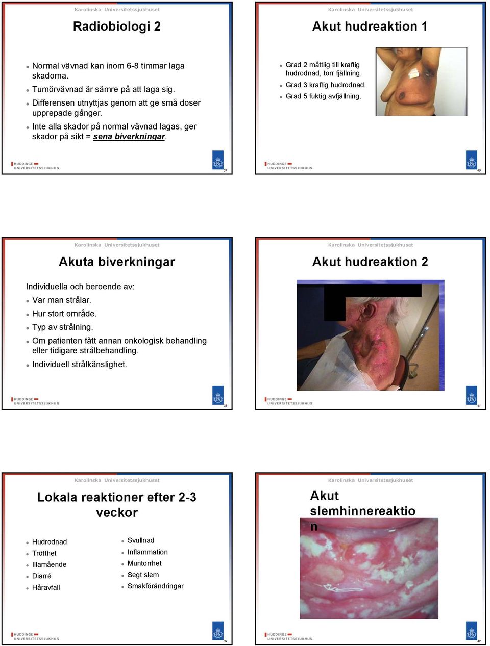 40 Akuta biverkningar Akut hudreaktion 2 Individuella och beroende av: Var man strålar. Hur stort område. Typ av strålning.