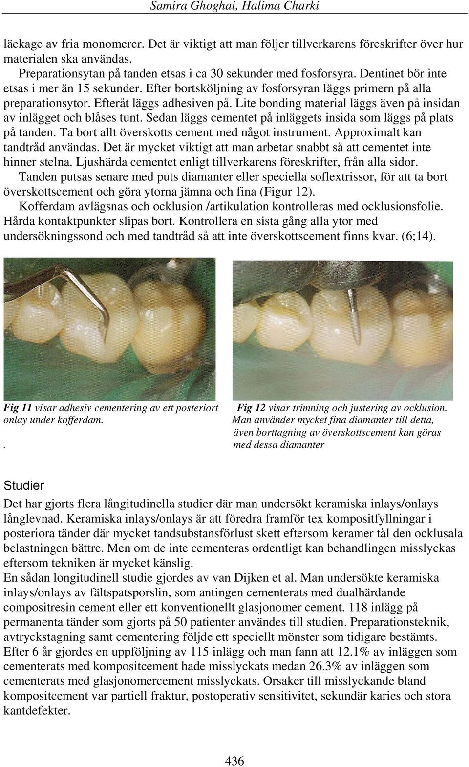 Lite bonding material läggs även på insidan av inlägget och blåses tunt. Sedan läggs cementet på inläggets insida som läggs på plats på tanden. Ta bort allt överskotts cement med något instrument.