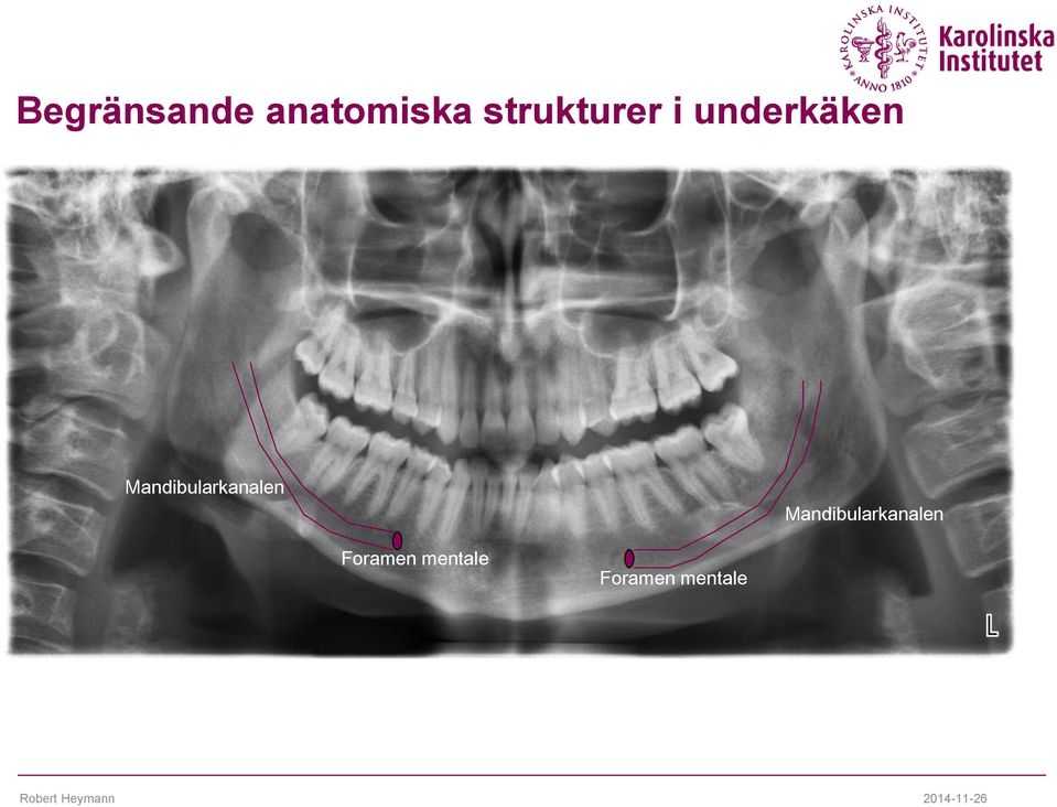 Mandibularkanalen