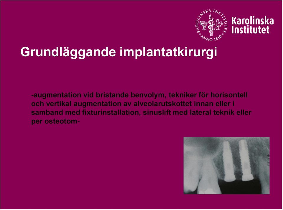 augmentation av alveolarutskottet innan eller i samband