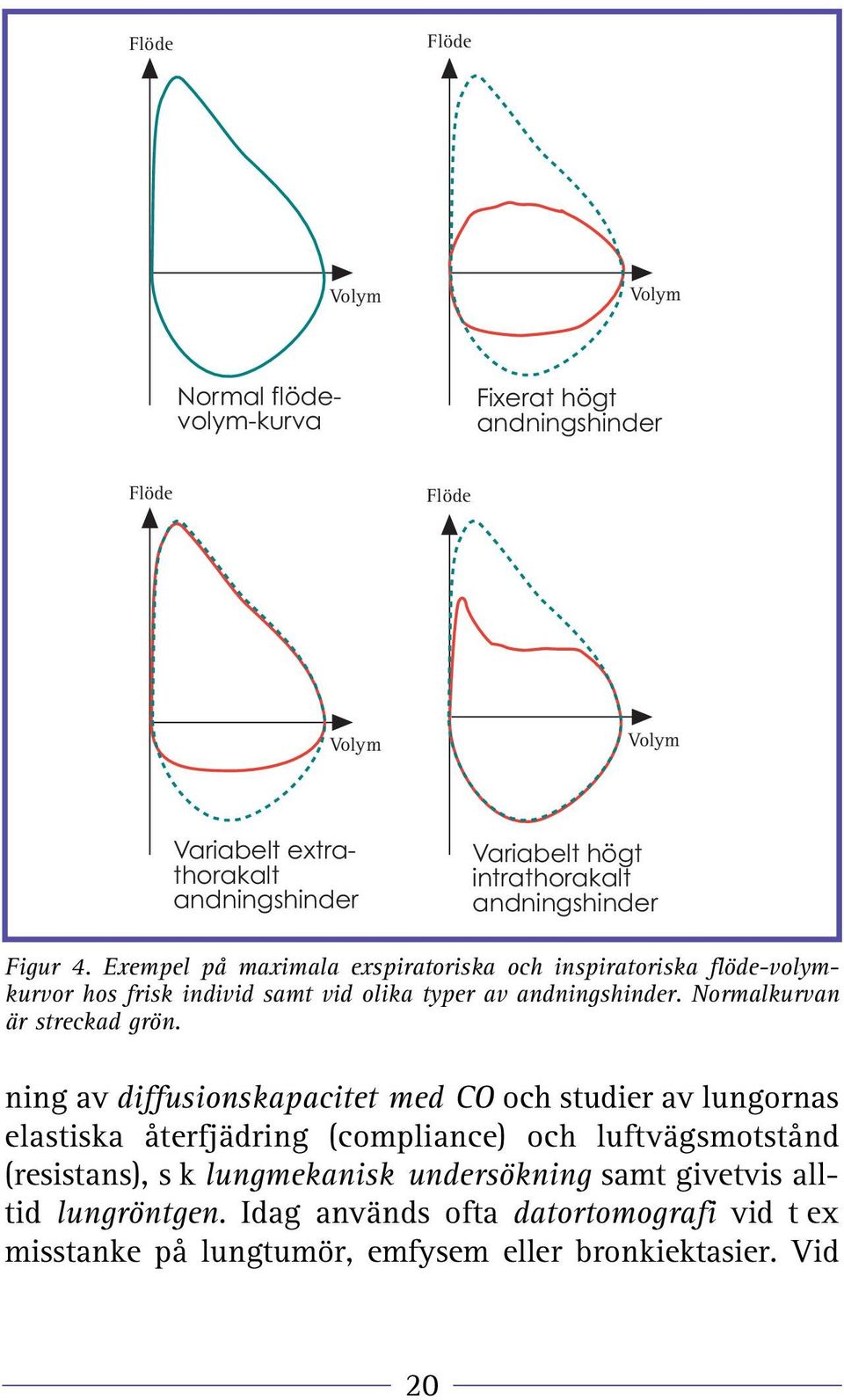 Exempel på maximala exspiratoriska och inspiratoriska flöde-volymkurvor hos frisk individ samt vid olika typer av andningshinder. Normalkurvan är streckad grön.