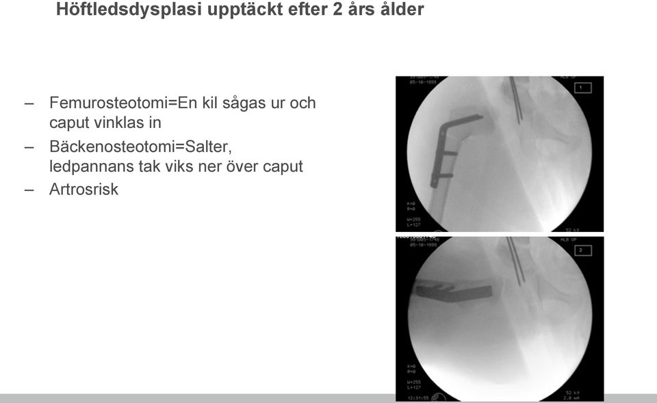 caput vinklas in Bäckenosteotomi=Salter,