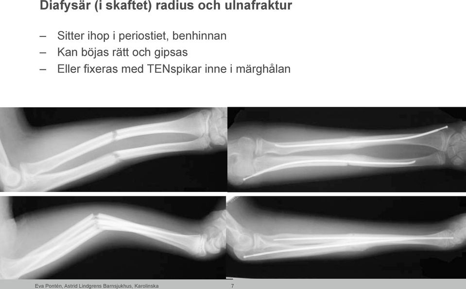 gipsas Eller fixeras med TENspikar inne i märghålan