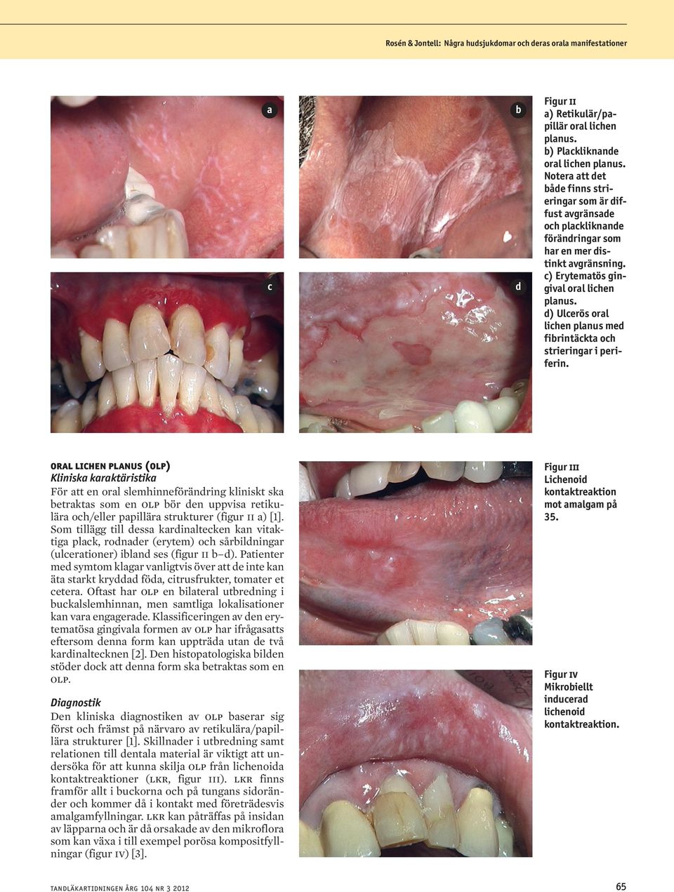 d) Ulcerös oral lichen planus med fibrintäckta och strieringar i periferin.