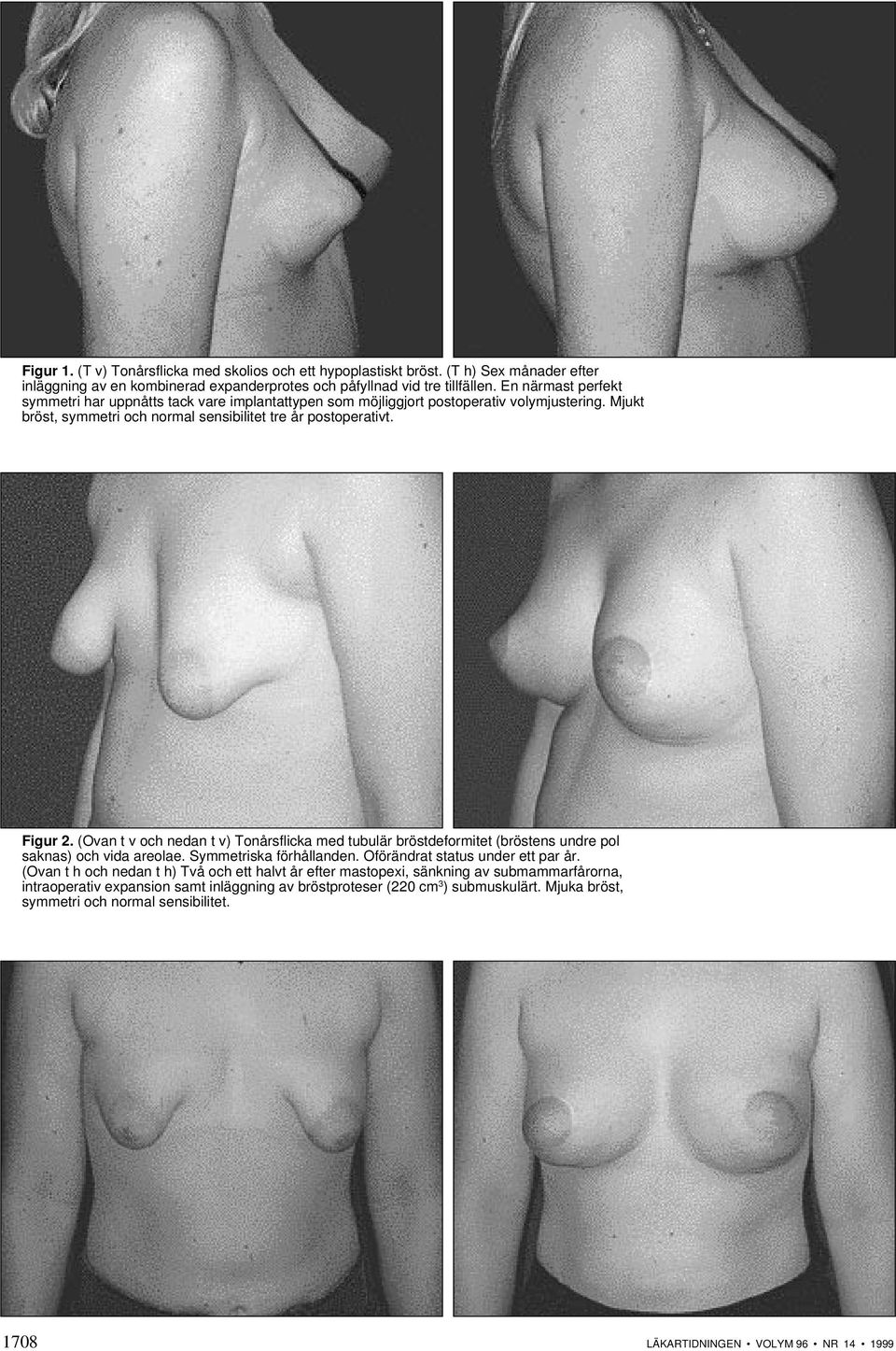 (Ovan t v och nedan t v) Tonårsflicka med tubulär bröstdeformitet (bröstens undre pol saknas) och vida areolae. Symmetriska förhållanden. Oförändrat status under ett par år.