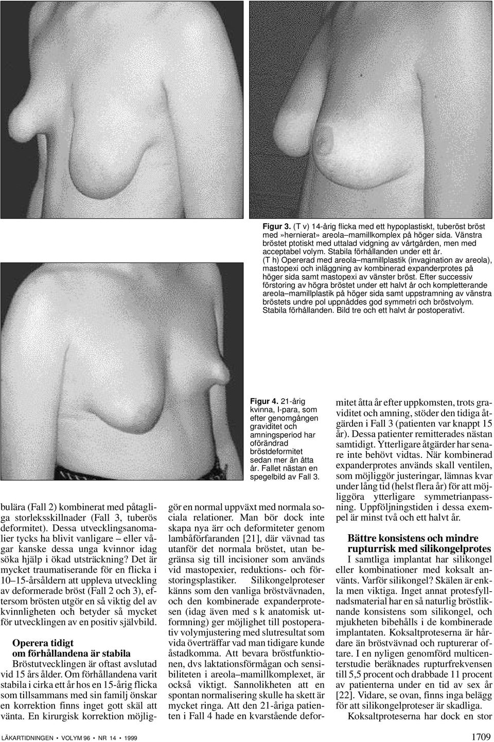 (T h) Opererad med areola mamillplastik (invagination av areola), mastopexi och inläggning av kombinerad expanderprotes på höger sida samt mastopexi av vänster bröst.
