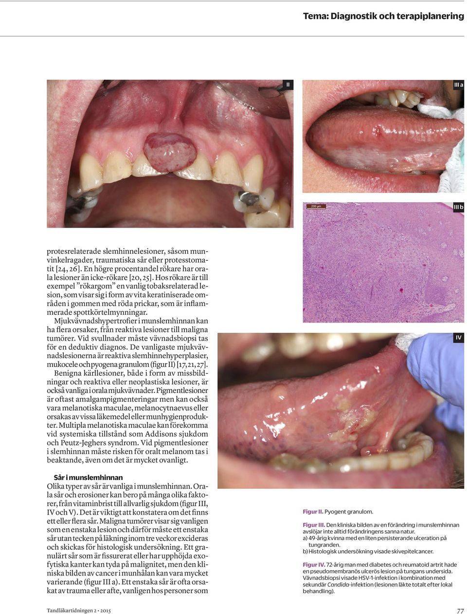 Hos rökare är till exempel rökargom en vanlig tobaksrelaterad lesion, som visar sig i form av vita keratiniserade områden i gommen med röda prickar, som är inflammerade spottkörtelmynningar.