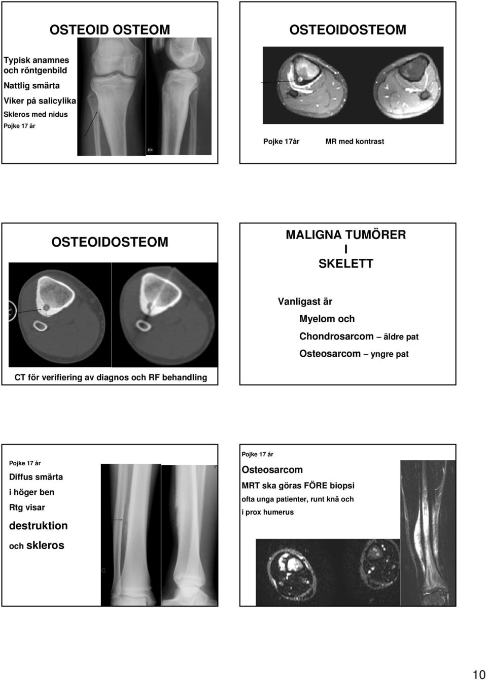 Osteosarcom yngre pat CT för verifiering av diagnos och RF behandling Pojke 17 år Diffus smärta i höger ben Rtg visar