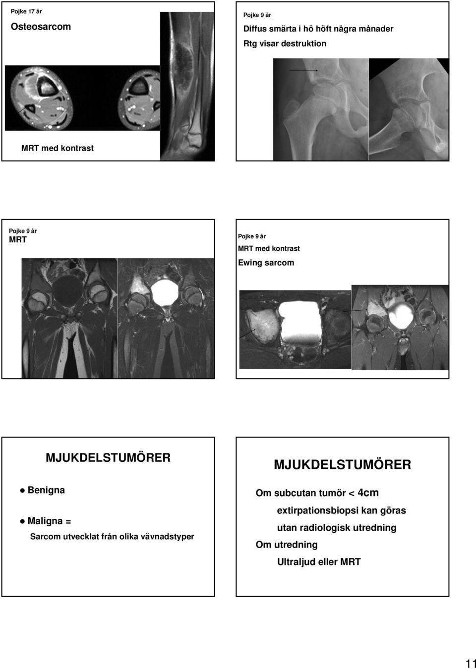 MJUKDELSTUMÖRER Benigna Maligna = Sarcom utvecklat från olika vävnadstyper MJUKDELSTUMÖRER Om