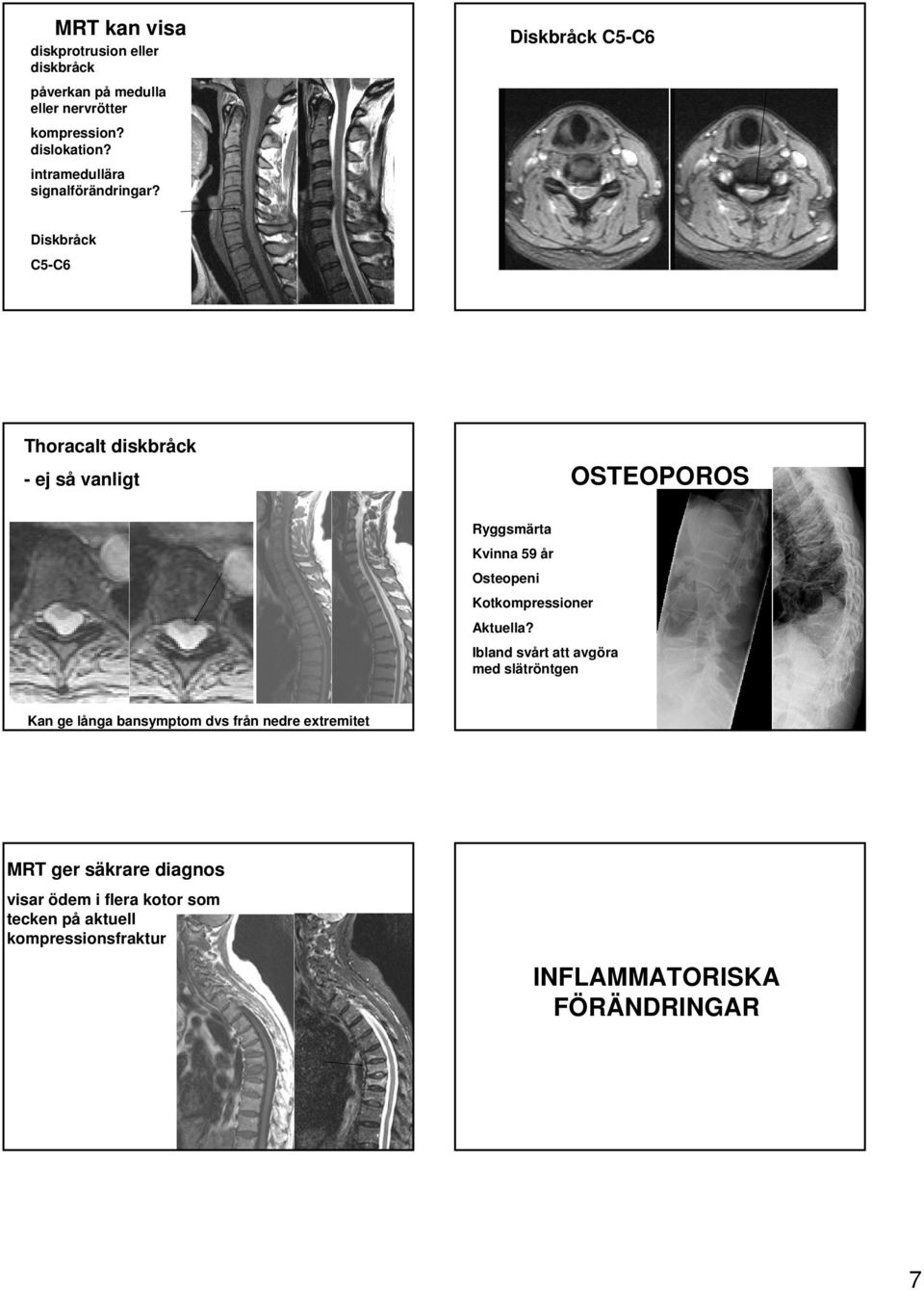 Diskbråck C5-C6 Diskbråck C5-C6 Thoracalt diskbråck - ej så vanligt OSTEOPOROS Ryggsmärta Kvinna 59 år Osteopeni