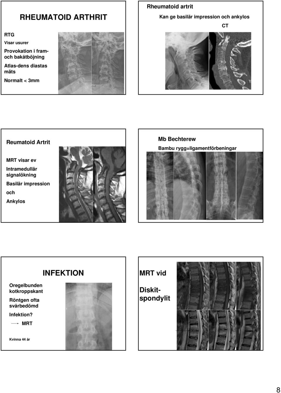 rygg=ligamentförbeningar MRT visar ev Intramedullär signalökning Basilär impression och Ankylos