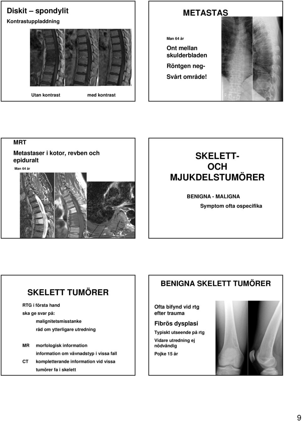 SKELETT- OCH MJUKDELSTUMÖRER BENIGNA - MALIGNA Symptom ofta ospecifika SKELETT TUMÖRER RTG i första hand ska ge svar på: malignitetsmisstanke råd om