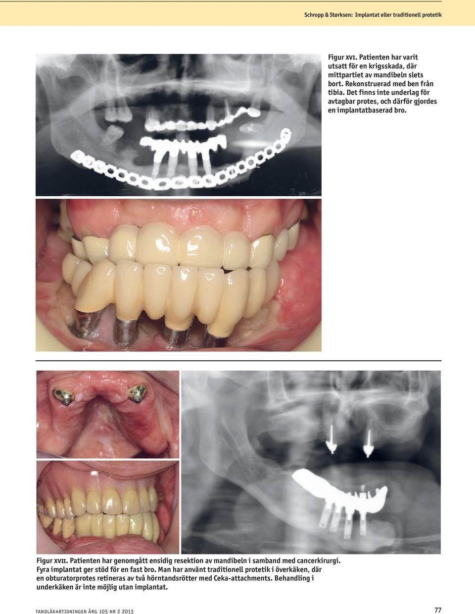 Det finns inte underlag för avtagbar protes, och därför gjordes en implantatbaserad bro. Figur xvii.