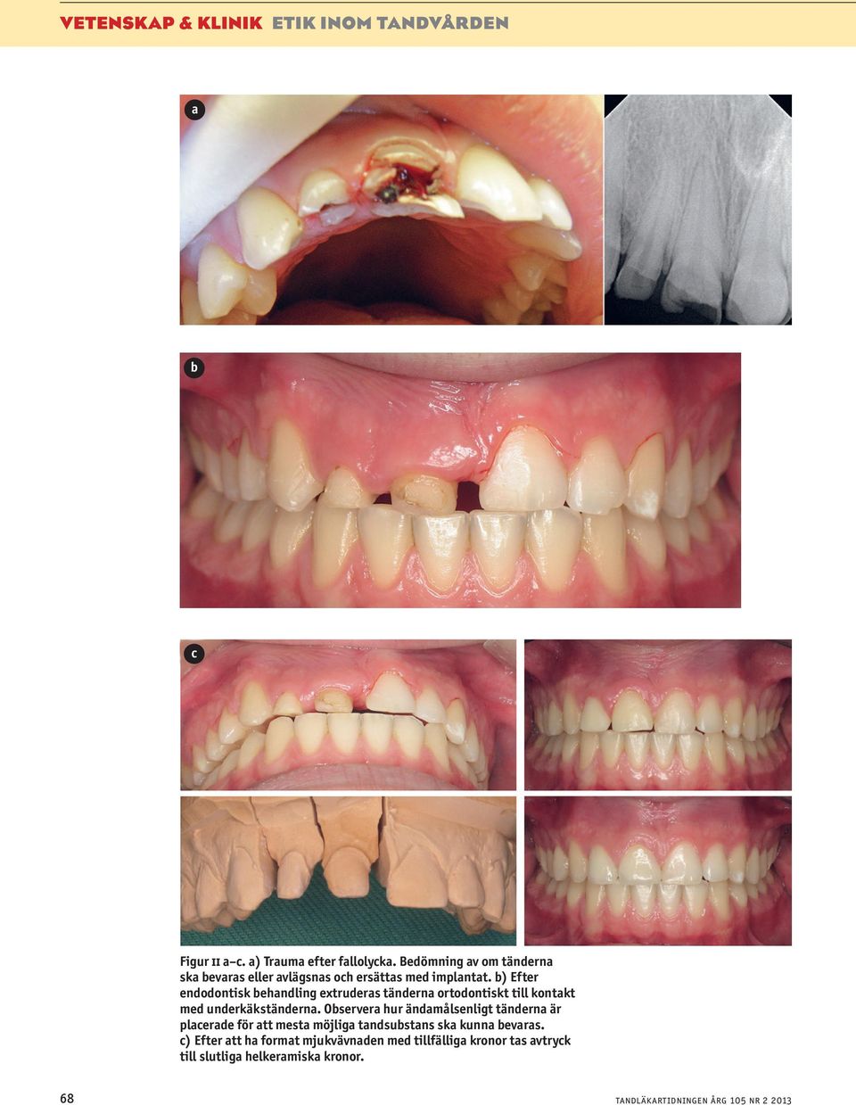 b) Efter endodontisk behandling extruderas tänderna ortodontiskt till kontakt med underkäkständerna.
