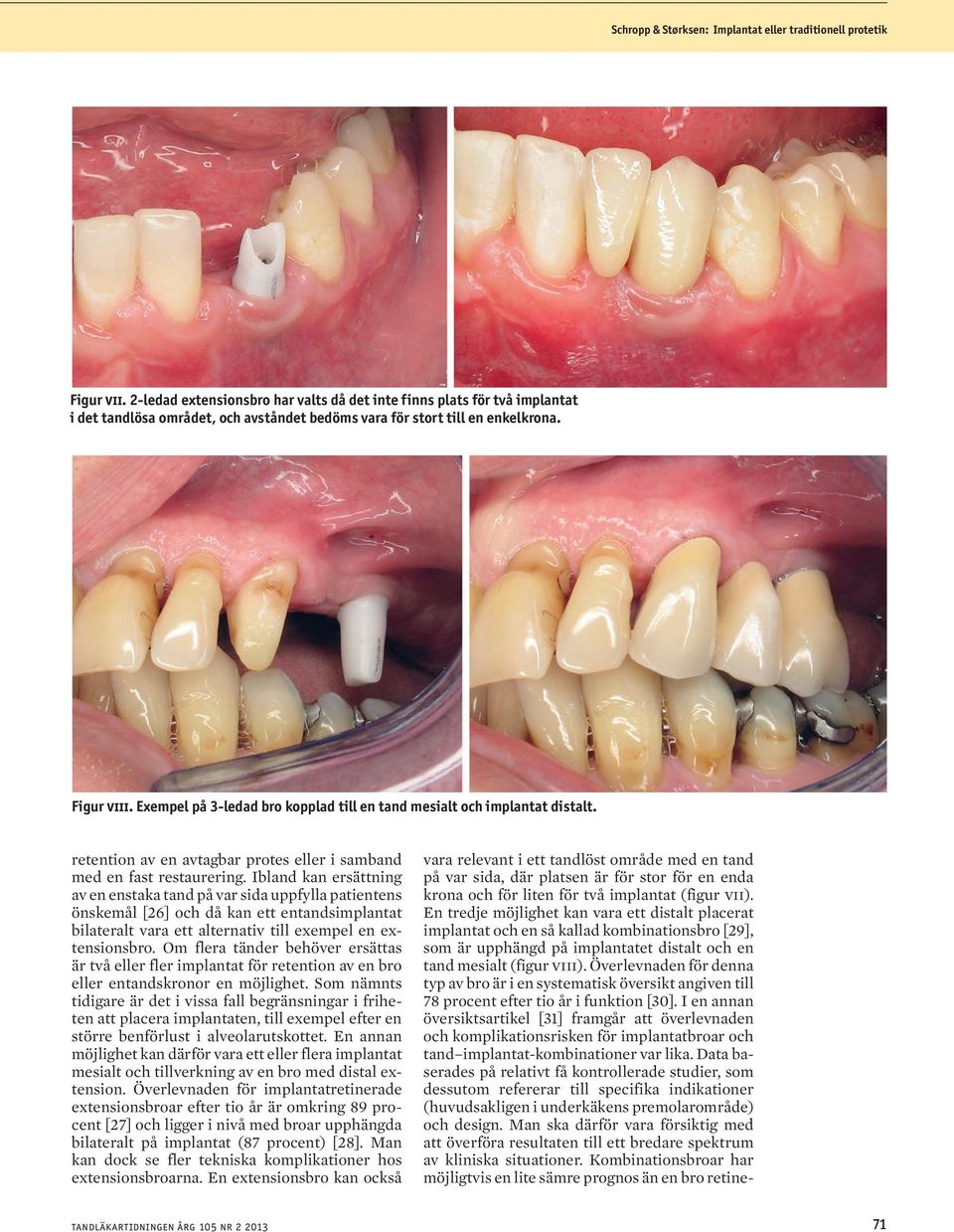 Exempel på 3-ledad bro kopplad till en tand mesialt och implantat distalt. retention av en avtagbar protes eller i samband med en fast restaurering.