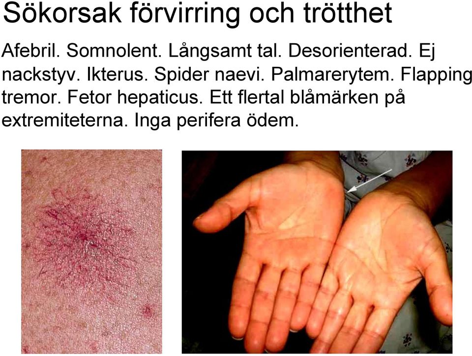 Spider naevi. Palmarerytem. Flapping tremor.