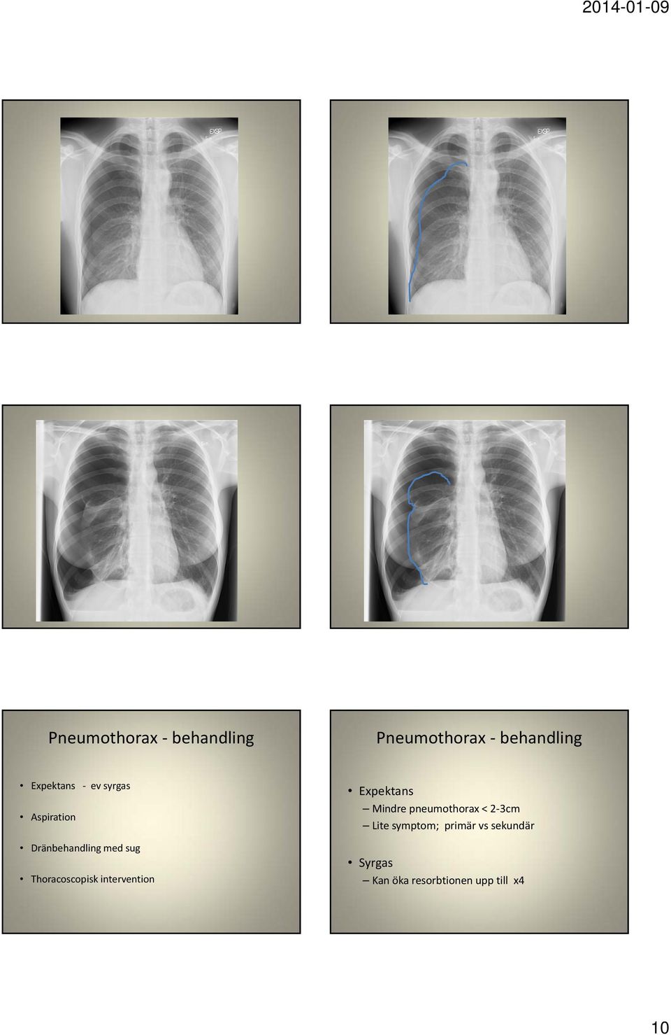 Thoracoscopisk intervention Expektans Mindre pneumothorax < 2 3cm